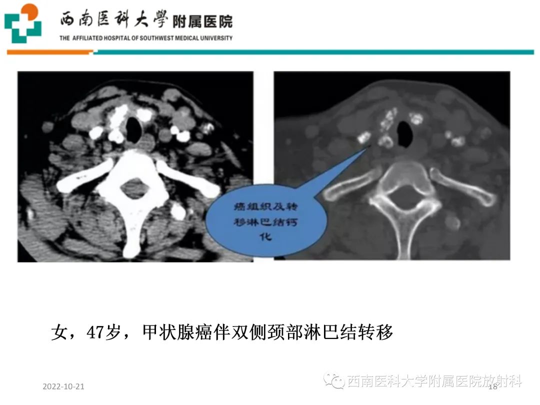 影像PPT - 【PPT】颈动脉间隙常见病变的影像诊断-18