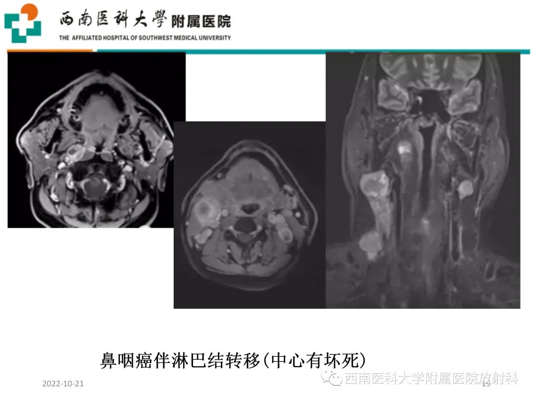 影像PPT - 【PPT】颈动脉间隙常见病变的影像诊断-19
