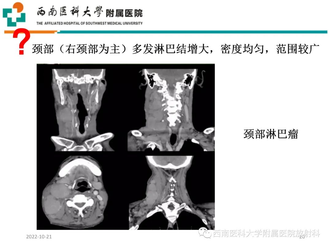 影像PPT - 【PPT】颈动脉间隙常见病变的影像诊断-20