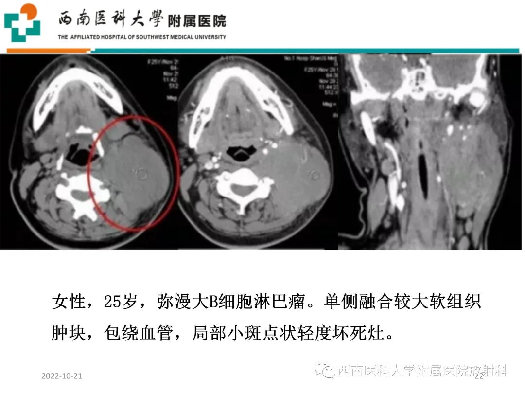 影像PPT - 【PPT】颈动脉间隙常见病变的影像诊断-22