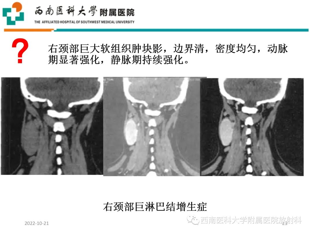 影像PPT - 【PPT】颈动脉间隙常见病变的影像诊断-23