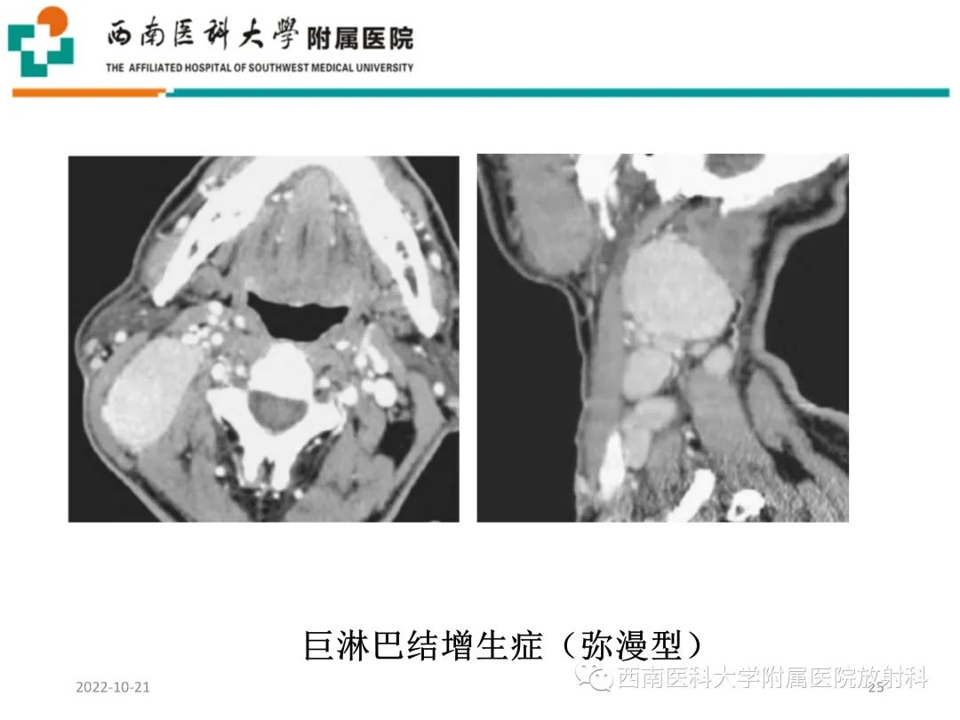 影像PPT - 【PPT】颈动脉间隙常见病变的影像诊断-25