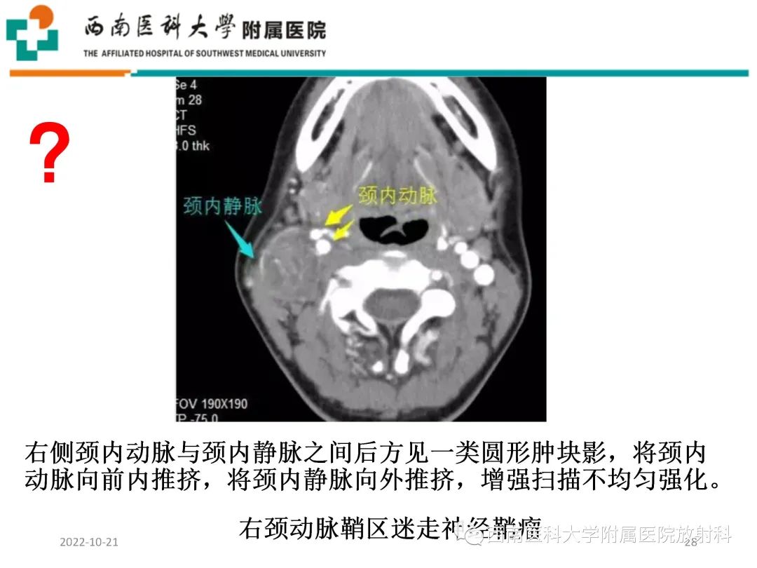 影像PPT - 【PPT】颈动脉间隙常见病变的影像诊断-28