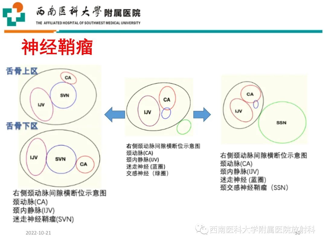 影像PPT - 【PPT】颈动脉间隙常见病变的影像诊断-30