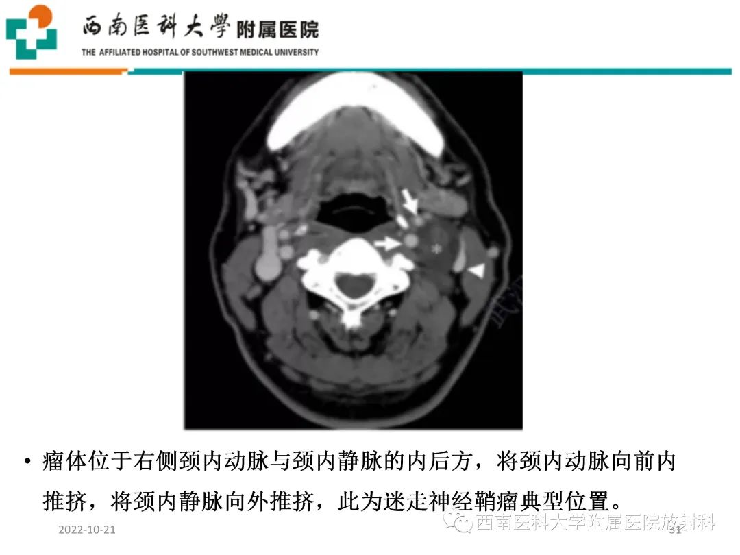 影像PPT - 【PPT】颈动脉间隙常见病变的影像诊断-31