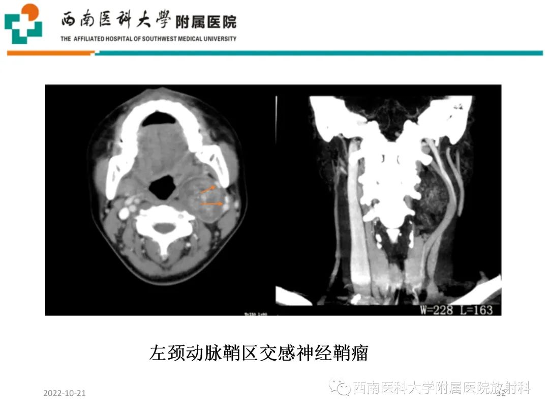 影像PPT - 【PPT】颈动脉间隙常见病变的影像诊断-32