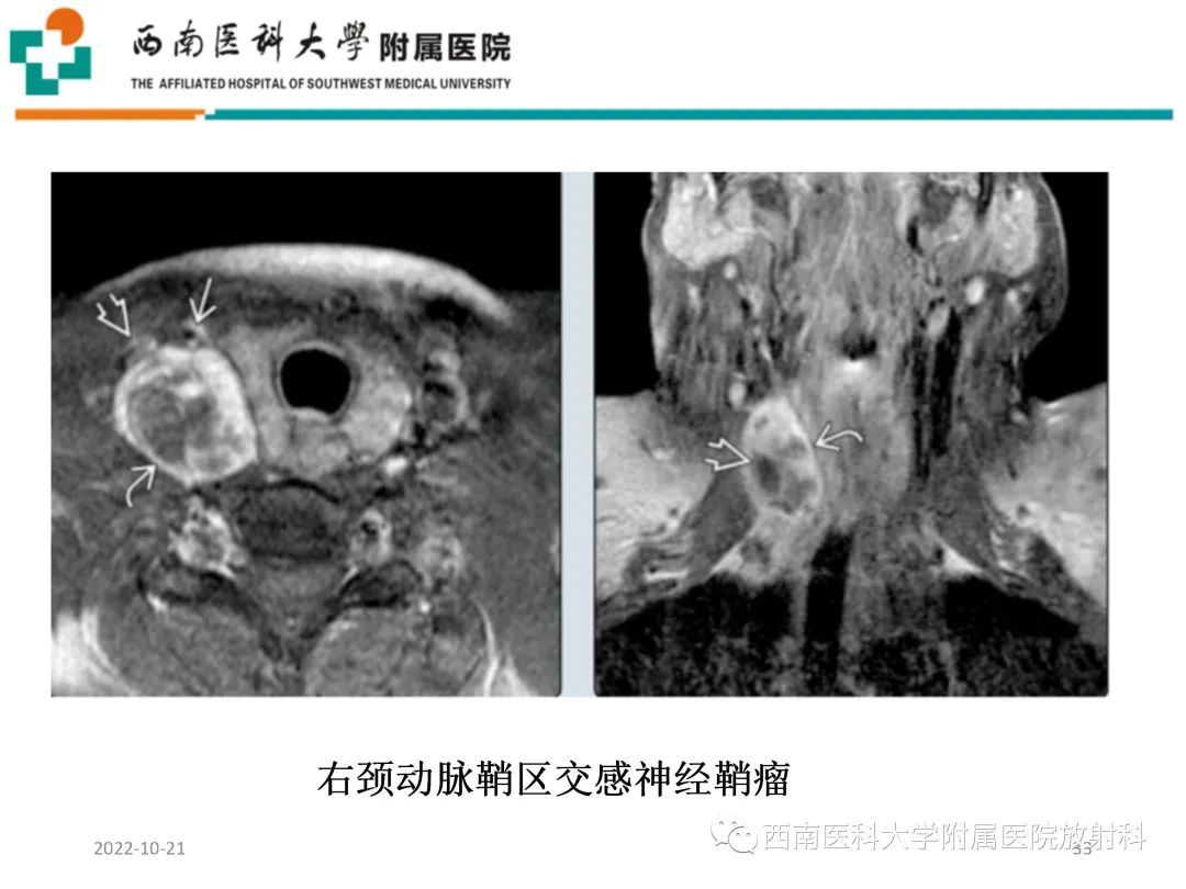 影像PPT - 【PPT】颈动脉间隙常见病变的影像诊断-33