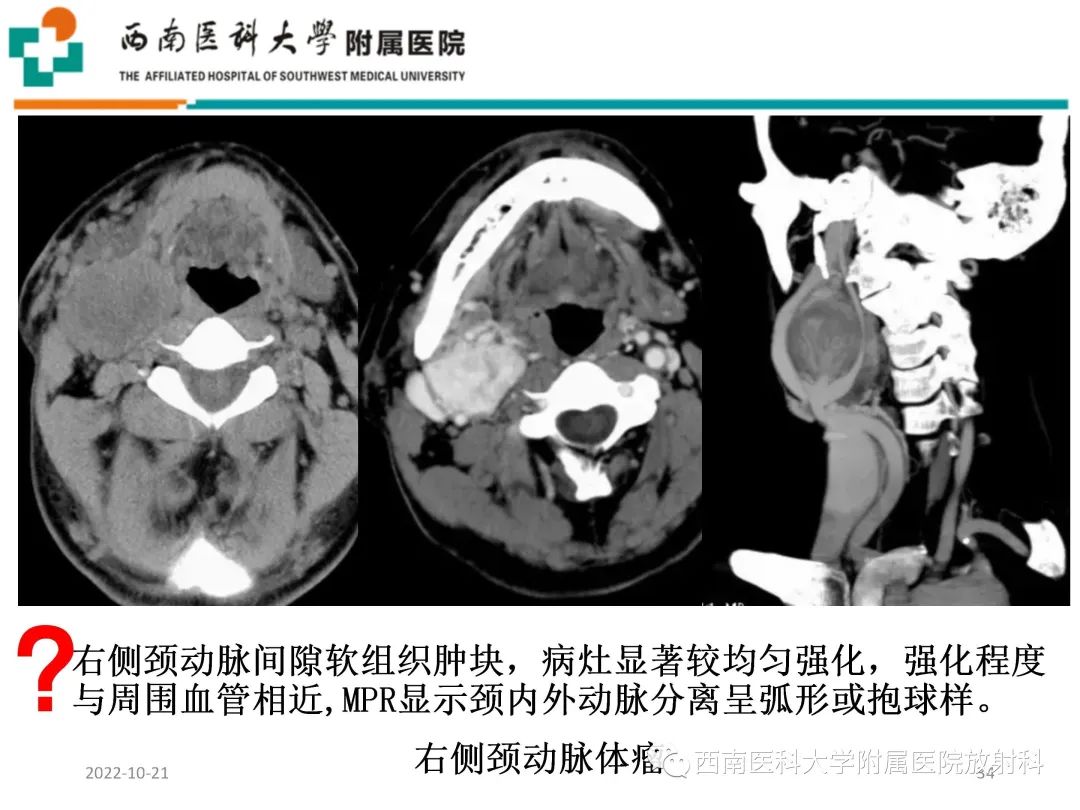 影像PPT - 【PPT】颈动脉间隙常见病变的影像诊断-34