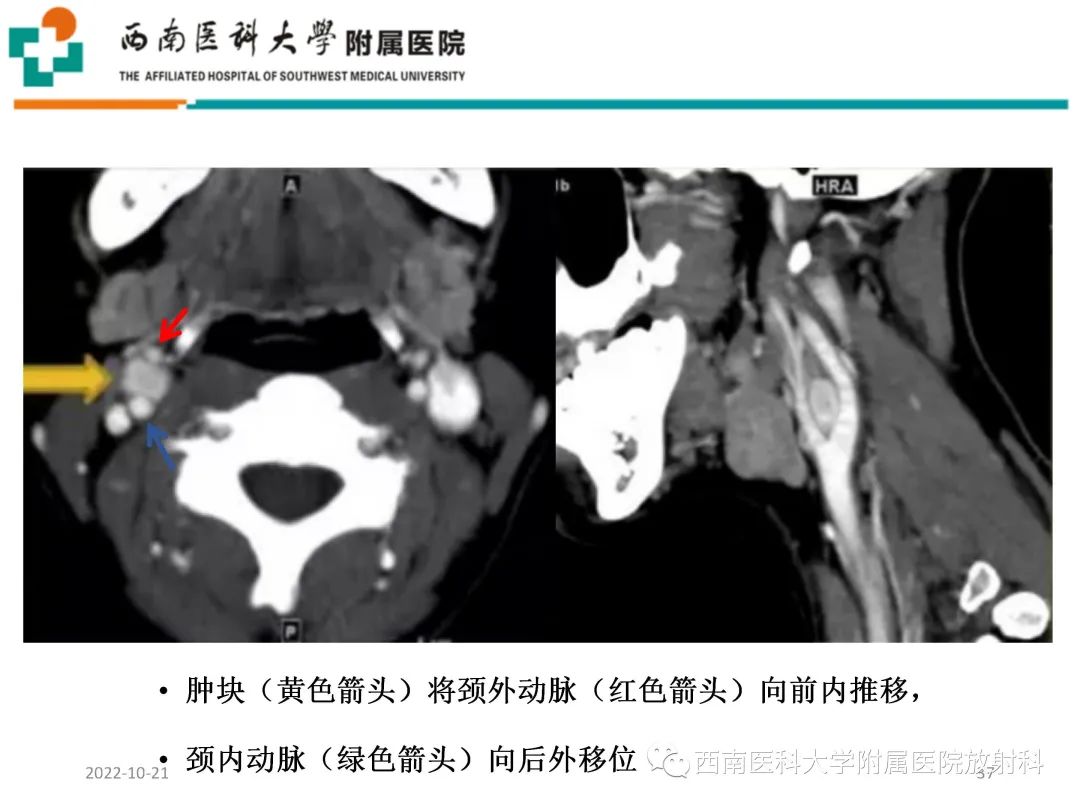 影像PPT - 【PPT】颈动脉间隙常见病变的影像诊断-37