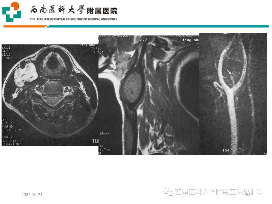 影像PPT - 【PPT】颈动脉间隙常见病变的影像诊断-38