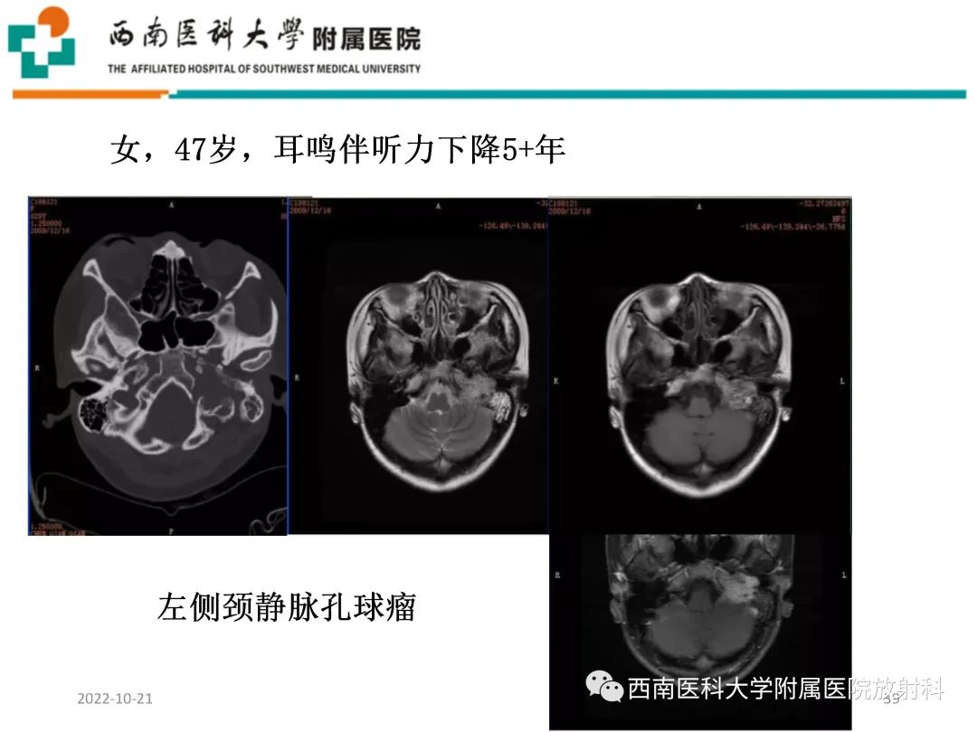 影像PPT - 【PPT】颈动脉间隙常见病变的影像诊断-39