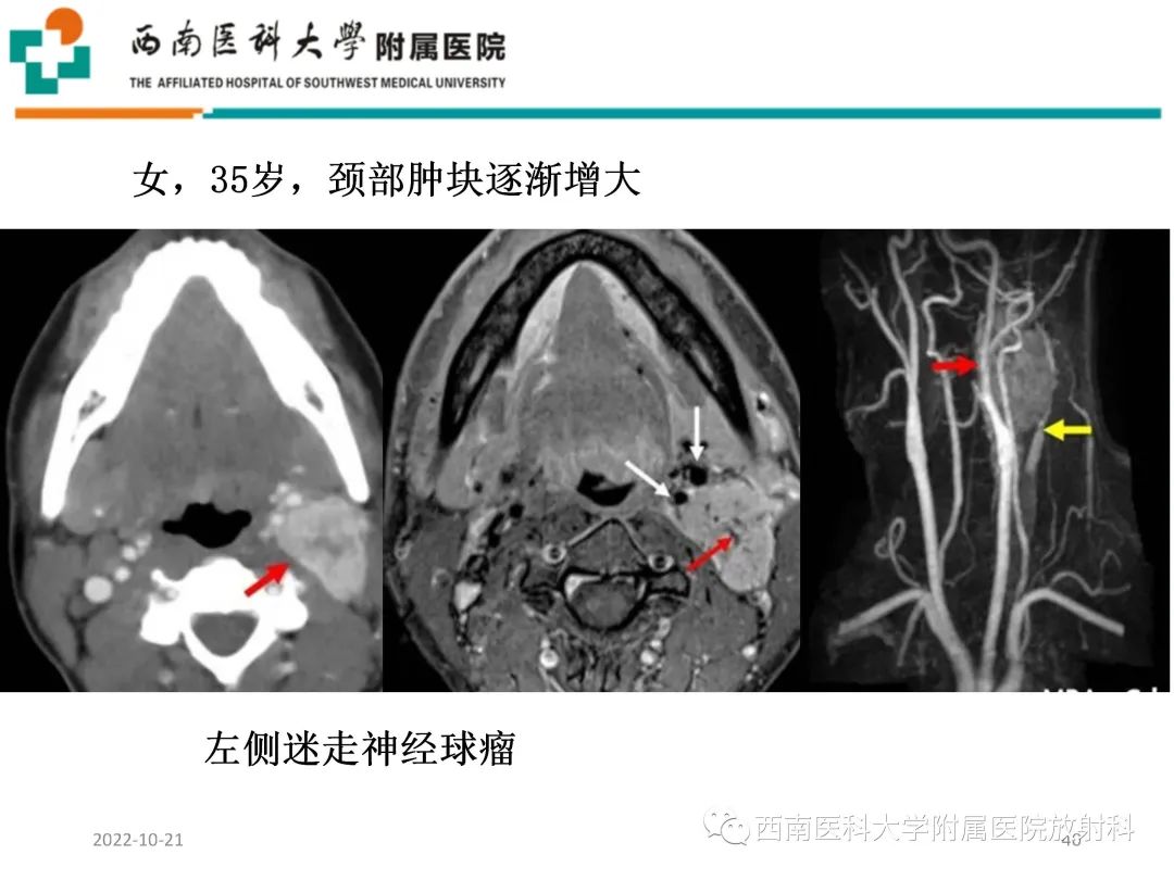 影像PPT - 【PPT】颈动脉间隙常见病变的影像诊断-40