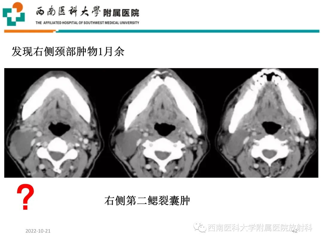 影像PPT - 【PPT】颈动脉间隙常见病变的影像诊断-42