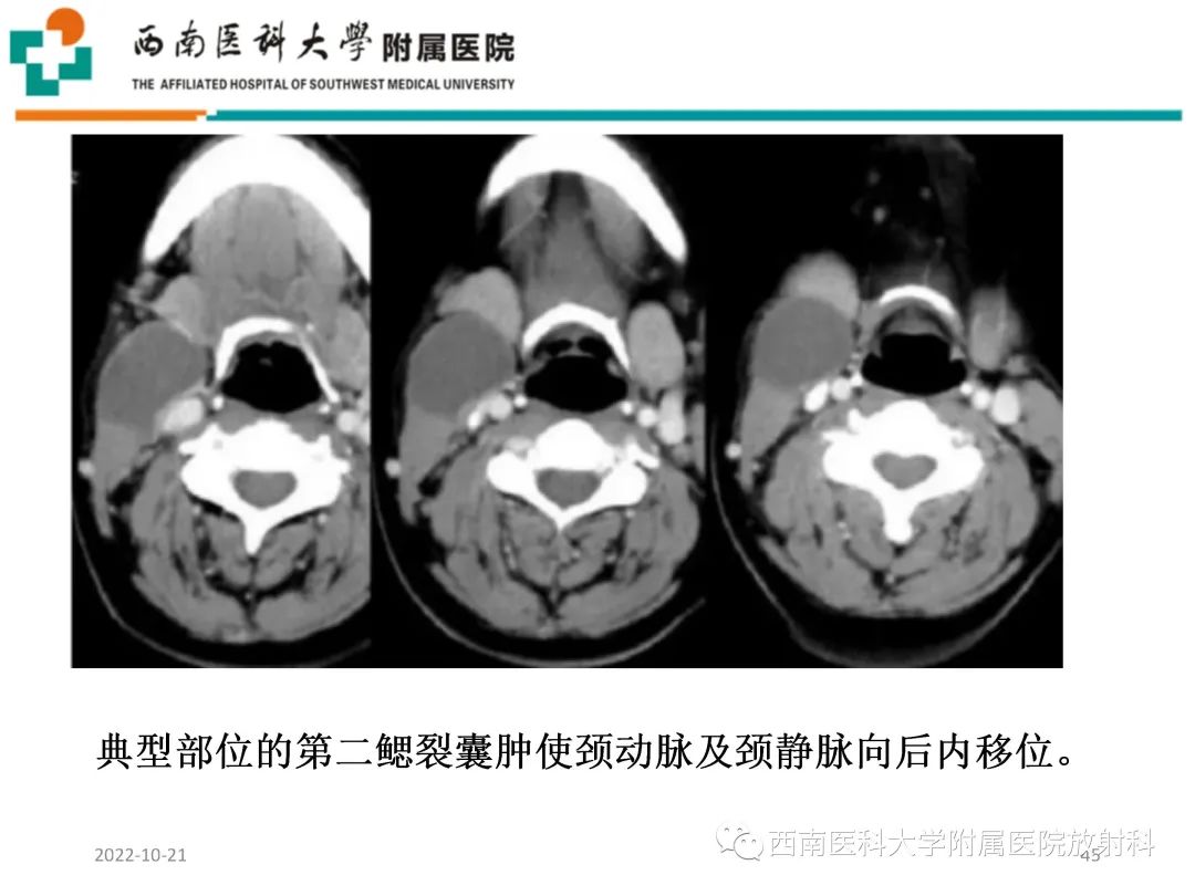 影像PPT - 【PPT】颈动脉间隙常见病变的影像诊断-45