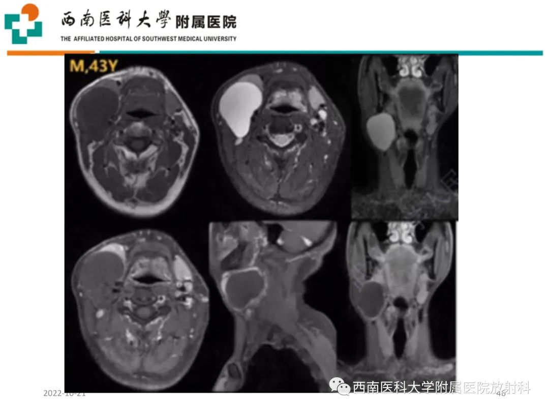 影像PPT - 【PPT】颈动脉间隙常见病变的影像诊断-46