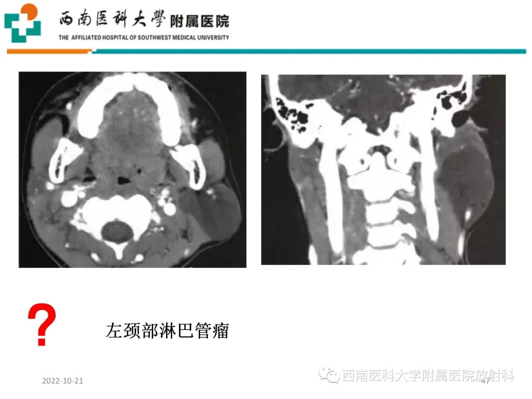 影像PPT - 【PPT】颈动脉间隙常见病变的影像诊断-47