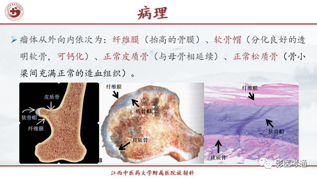 影像PPT - 【PPT】骨软骨瘤影像诊断与鉴别-2 影像PPT - 【PPT】骨软骨瘤影像诊断与鉴别-2