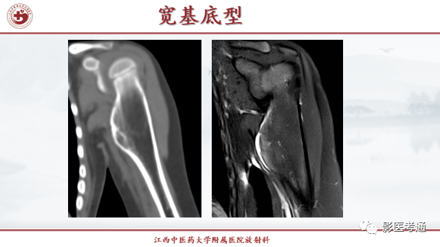 影像PPT - 【PPT】骨软骨瘤影像诊断与鉴别-5 影像PPT - 【PPT】骨软骨瘤影像诊断与鉴别-5