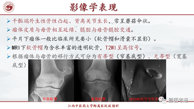 影像PPT - 【PPT】骨软骨瘤影像诊断与鉴别-3 影像PPT - 【PPT】骨软骨瘤影像诊断与鉴别-3
