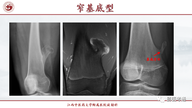 影像PPT - 【PPT】骨软骨瘤影像诊断与鉴别-6 影像PPT - 【PPT】骨软骨瘤影像诊断与鉴别-6