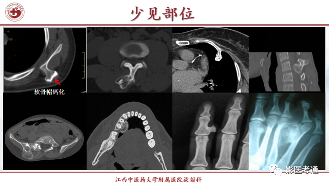 影像PPT - 【PPT】骨软骨瘤影像诊断与鉴别-7 影像PPT - 【PPT】骨软骨瘤影像诊断与鉴别-7
