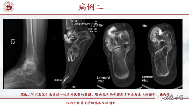 影像PPT - 【PPT】骨软骨瘤影像诊断与鉴别-8 影像PPT - 【PPT】骨软骨瘤影像诊断与鉴别-8