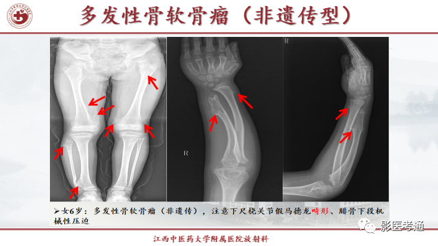 影像PPT - 【PPT】骨软骨瘤影像诊断与鉴别-9 影像PPT - 【PPT】骨软骨瘤影像诊断与鉴别-9