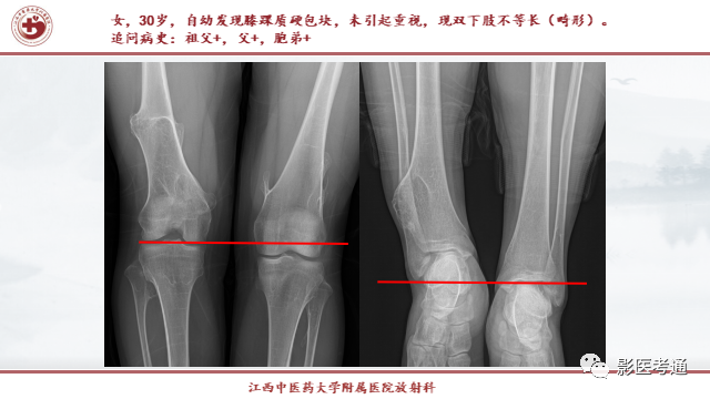 影像PPT - 【PPT】骨软骨瘤影像诊断与鉴别-11 影像PPT - 【PPT】骨软骨瘤影像诊断与鉴别-11