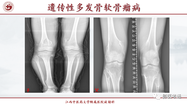 影像PPT - 【PPT】骨软骨瘤影像诊断与鉴别-10 影像PPT - 【PPT】骨软骨瘤影像诊断与鉴别-10