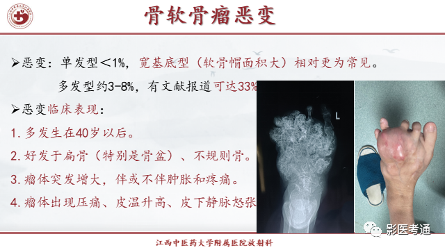 影像PPT - 【PPT】骨软骨瘤影像诊断与鉴别-12 影像PPT - 【PPT】骨软骨瘤影像诊断与鉴别-12
