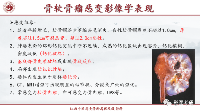 影像PPT - 【PPT】骨软骨瘤影像诊断与鉴别-13 影像PPT - 【PPT】骨软骨瘤影像诊断与鉴别-13