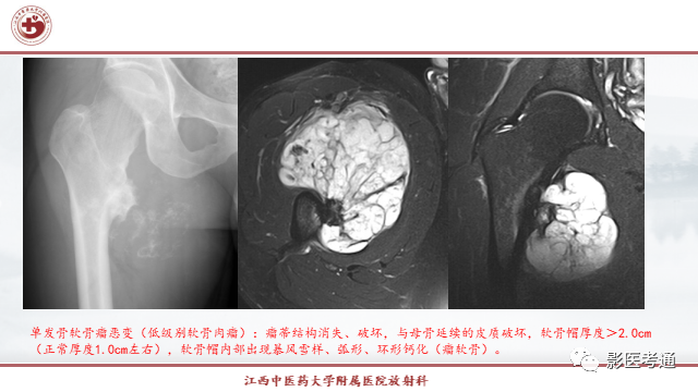 影像PPT - 【PPT】骨软骨瘤影像诊断与鉴别-14 影像PPT - 【PPT】骨软骨瘤影像诊断与鉴别-14