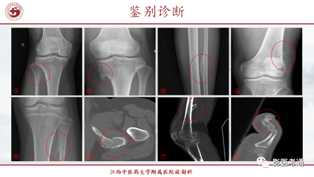 影像PPT - 【PPT】骨软骨瘤影像诊断与鉴别-16 影像PPT - 【PPT】骨软骨瘤影像诊断与鉴别-16