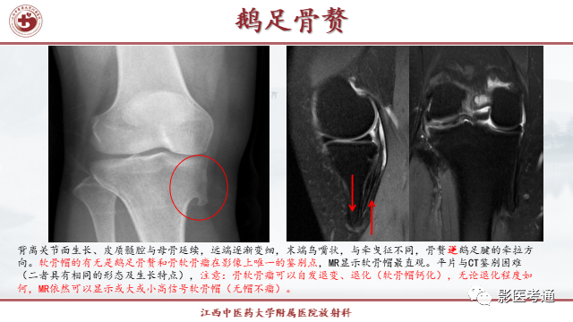 影像PPT - 【PPT】骨软骨瘤影像诊断与鉴别-21 影像PPT - 【PPT】骨软骨瘤影像诊断与鉴别-21
