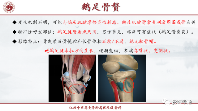 影像PPT - 【PPT】骨软骨瘤影像诊断与鉴别-20 影像PPT - 【PPT】骨软骨瘤影像诊断与鉴别-20