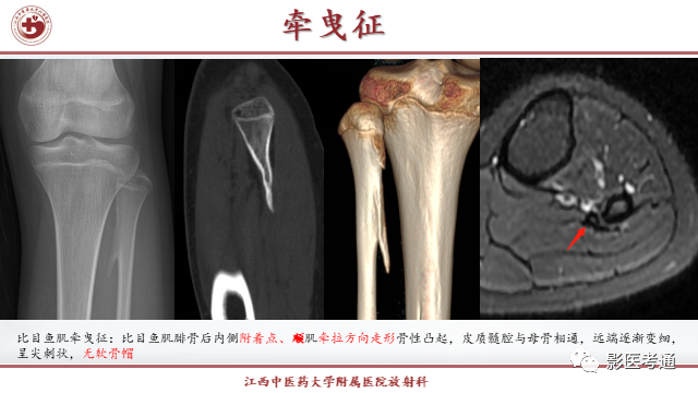 影像PPT - 【PPT】骨软骨瘤影像诊断与鉴别-19 影像PPT - 【PPT】骨软骨瘤影像诊断与鉴别-19