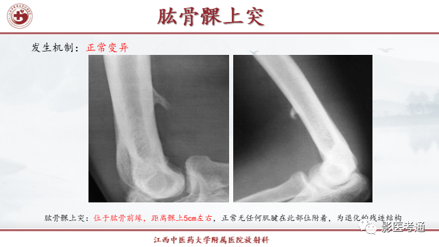 影像PPT - 【PPT】骨软骨瘤影像诊断与鉴别-22 影像PPT - 【PPT】骨软骨瘤影像诊断与鉴别-22