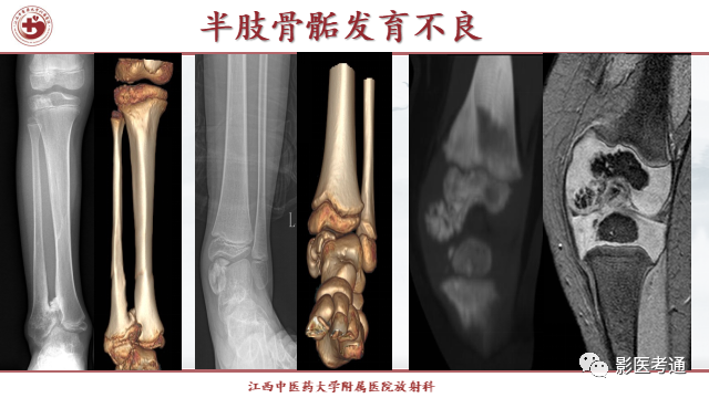 影像PPT - 【PPT】骨软骨瘤影像诊断与鉴别-24 影像PPT - 【PPT】骨软骨瘤影像诊断与鉴别-24