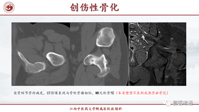 影像PPT - 【PPT】骨软骨瘤影像诊断与鉴别-25 影像PPT - 【PPT】骨软骨瘤影像诊断与鉴别-25