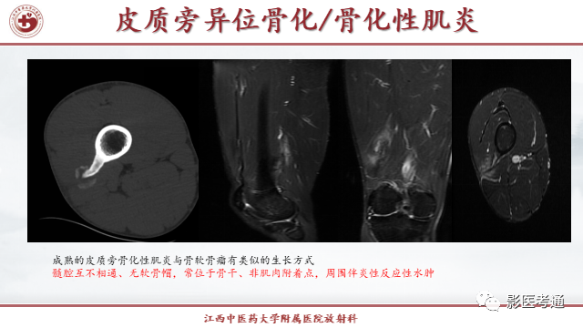 影像PPT - 【PPT】骨软骨瘤影像诊断与鉴别-26 影像PPT - 【PPT】骨软骨瘤影像诊断与鉴别-26
