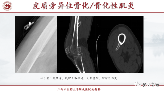 影像PPT - 【PPT】骨软骨瘤影像诊断与鉴别-27 影像PPT - 【PPT】骨软骨瘤影像诊断与鉴别-27