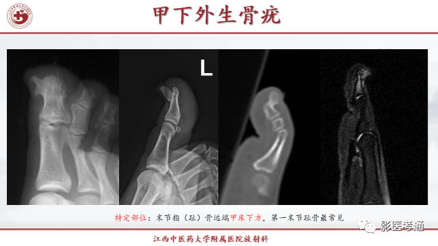 影像PPT - 【PPT】骨软骨瘤影像诊断与鉴别-28 影像PPT - 【PPT】骨软骨瘤影像诊断与鉴别-28