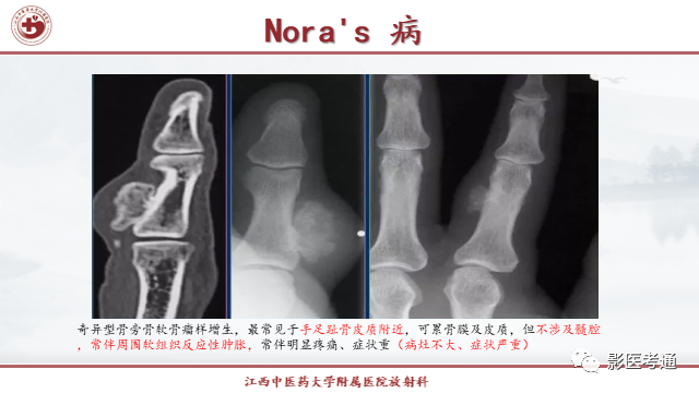 影像PPT - 【PPT】骨软骨瘤影像诊断与鉴别-29 影像PPT - 【PPT】骨软骨瘤影像诊断与鉴别-29