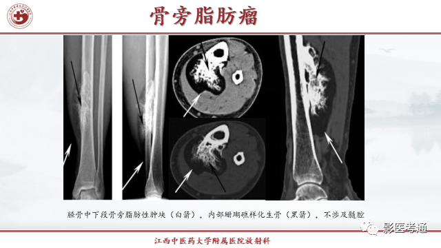 影像PPT - 【PPT】骨软骨瘤影像诊断与鉴别-31 影像PPT - 【PPT】骨软骨瘤影像诊断与鉴别-31