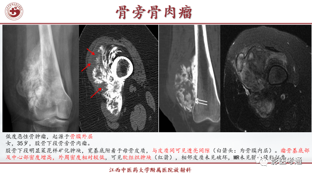 影像PPT - 【PPT】骨软骨瘤影像诊断与鉴别-32 影像PPT - 【PPT】骨软骨瘤影像诊断与鉴别-32