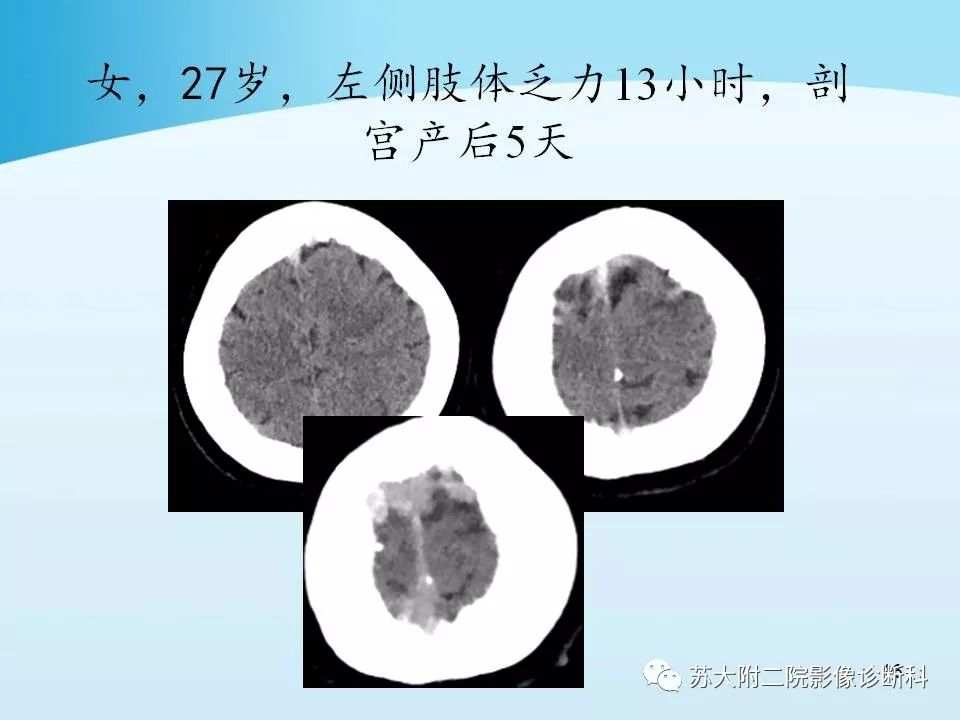 影像PPT - 【PPT】脑静脉血栓影像征象分析-16