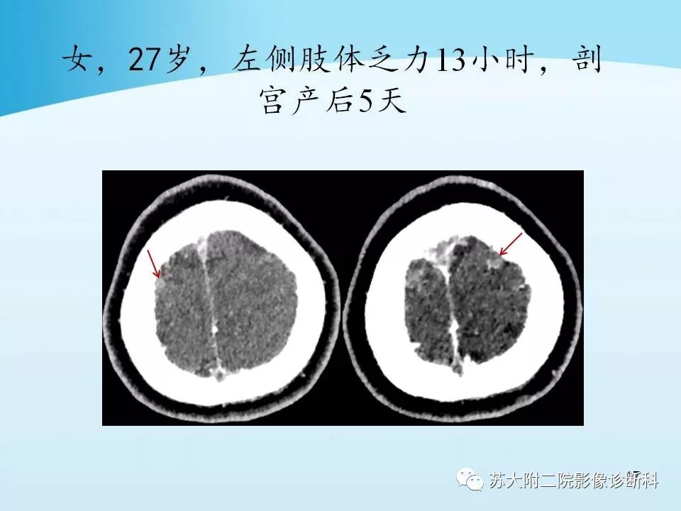 影像PPT - 【PPT】脑静脉血栓影像征象分析-17