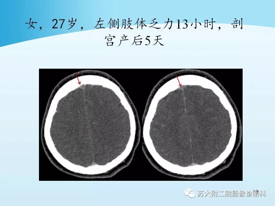影像PPT - 【PPT】脑静脉血栓影像征象分析-18