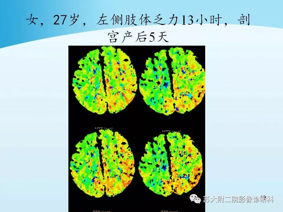 影像PPT - 【PPT】脑静脉血栓影像征象分析-19