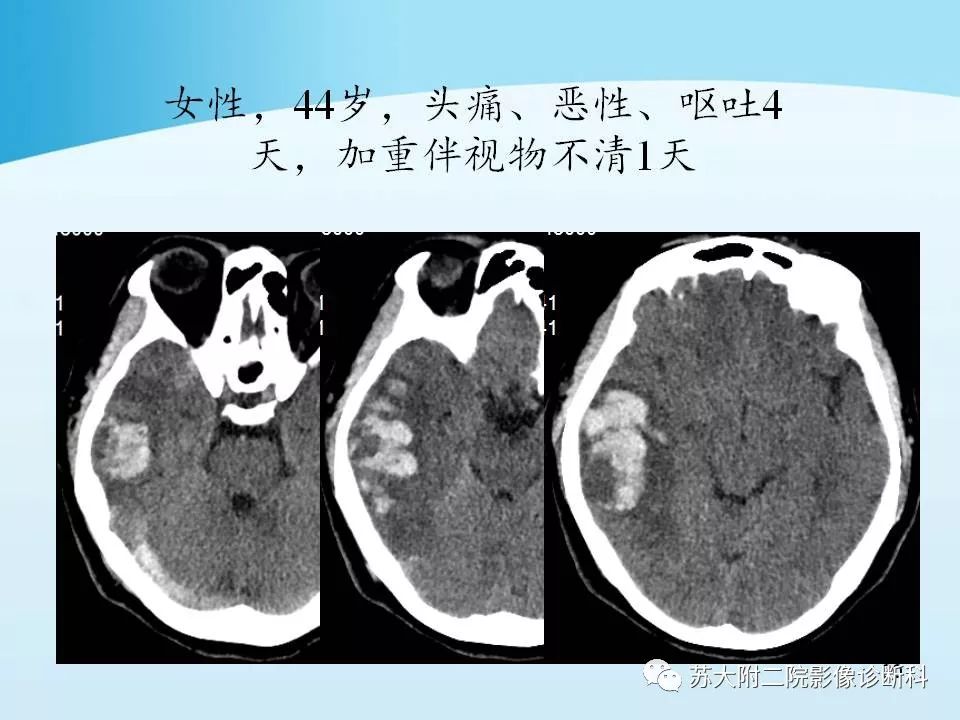 影像PPT - 【PPT】脑静脉血栓影像征象分析-20